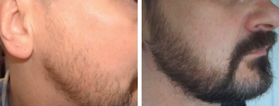 Minoxidil Bartwuchs nach 2 Monaten